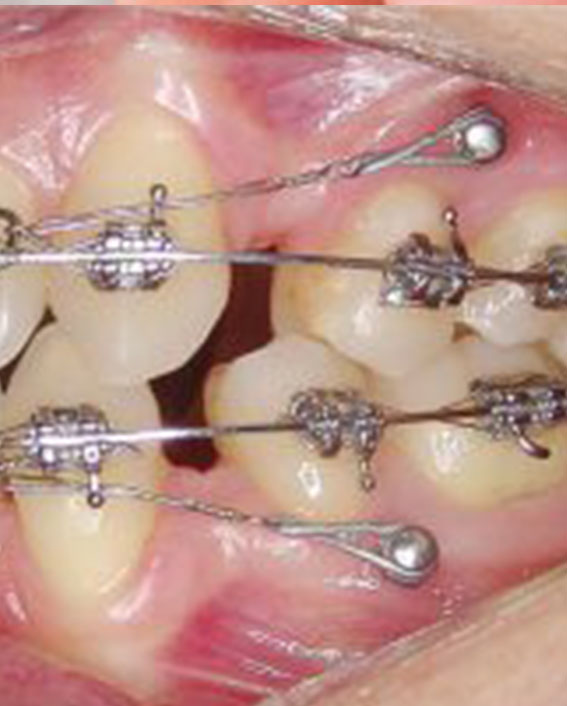EARLY TREATMENT